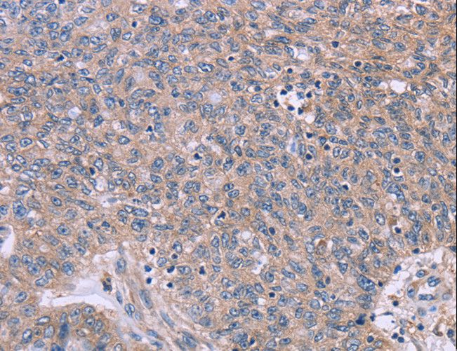 CSF2RB / CD131 Antibody - Immunohistochemistry of paraffin-embedded Human ovarian cancer using CSF2RB Polyclonal Antibody at dilution of 1:40.