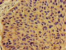 CSF2RB / CD131 Antibody - Immunohistochemistry image of paraffin-embedded human cervical cancer at a dilution of 1:100
