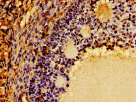 CSF2RB / CD131 Antibody - Immunohistochemistry image of paraffin-embedded human ovarian cancer at a dilution of 1:100
