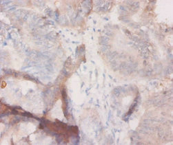 CSF3 / G-CSF Antibody - Immunohistochemistry of paraffin-embedded human colon cancer using CSF3 Antibody at dilution of 1:20