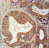 CSGALNACT1 Antibody - CSGALNACT1 Antibody immunohistochemistry of formalin-fixed and paraffin-embedded human prostate carcinoma followed by peroxidase-conjugated secondary antibody and DAB staining. This data demonstrates the use of the CSGALNACT1 Antibody for immunohistochemistry.