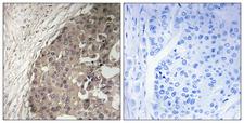 CSGALNACT1 Antibody - Immunohistochemistry analysis of paraffin-embedded human breast carcinoma tissue, using CSGALNACT1 Antibody. The picture on the right is blocked with the synthesized peptide.
