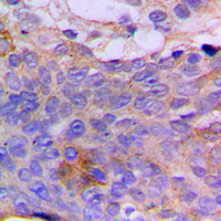 CSGALNACT1 Antibody - Immunohistochemical analysis of CSGALNACT1 staining in human breast cancer formalin fixed paraffin embedded tissue section. The section was pre-treated using heat mediated antigen retrieval with sodium citrate buffer (pH 6.0). The section was then incubated with the antibody at room temperature and detected using an HRP conjugated compact polymer system. DAB was used as the chromogen. The section was then counterstained with hematoxylin and mounted with DPX.