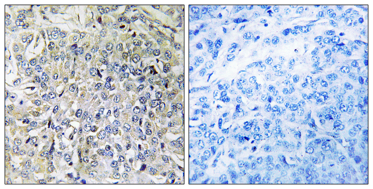 CSGALNACT2 Antibody - Immunohistochemistry analysis of paraffin-embedded human breast carcinoma tissue, using CSGALNACT2 Antibody. The picture on the right is blocked with the synthesized peptide.