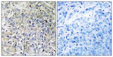 CSGALNACT2 Antibody - Peptide - + Immunohistochemistry analysis of paraffin-embedded human breast carcinoma tissue using CSGALNACT2 antibody.