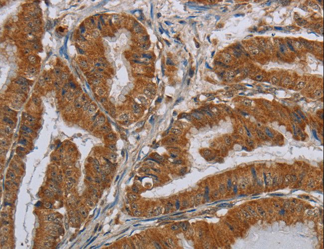 CSH1 / Placental Lactogen Antibody - Immunohistochemistry of paraffin-embedded Human esophagus cancer using CSH1 Polyclonal Antibody at dilution of 1:40.