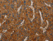 CSH1 / Placental Lactogen Antibody - Immunohistochemistry of paraffin-embedded Human liver cancer using CSH1 Polyclonal Antibody at dilution of 1:50.
