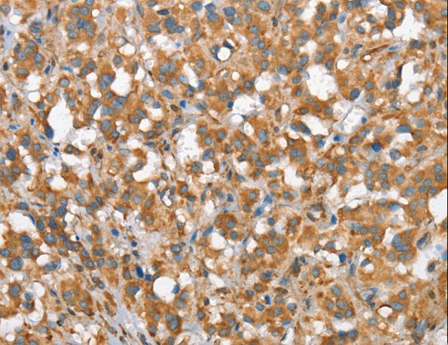 CSMD1 Antibody - Immunohistochemistry of paraffin-embedded Human gastric cancer using CSMD1 Polyclonal Antibody at dilution of 1:40.