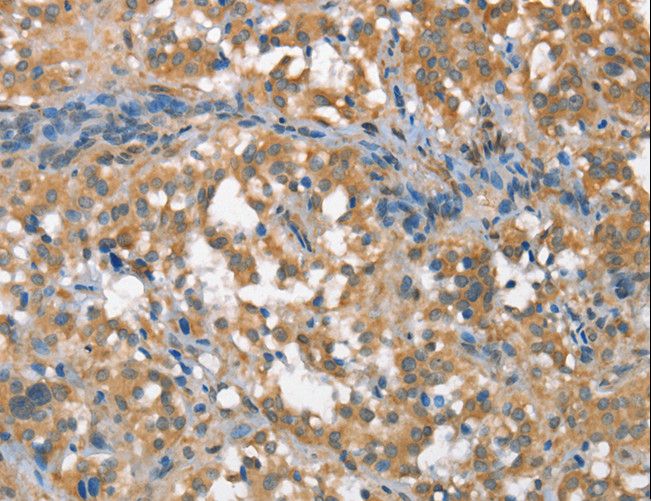CSMD1 Antibody - Immunohistochemistry of paraffin-embedded Human thyroid cancer using CSMD1 Polyclonal Antibody at dilution of 1:40.