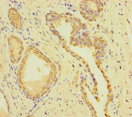 CSMD2 Antibody - Immunohistochemistry of paraffin-embedded human prostate cancer using CSMD2 Antibody at dilution of 1:100