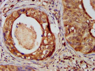 CSMD3 Antibody - Immunohistochemistry image at a dilution of 1:400 and staining in paraffin-embedded human cervical cancer performed on a Leica BondTM system. After dewaxing and hydration, antigen retrieval was mediated by high pressure in a citrate buffer (pH 6.0) . Section was blocked with 10% normal goat serum 30min at RT. Then primary antibody (1% BSA) was incubated at 4 °C overnight. The primary is detected by a biotinylated secondary antibody and visualized using an HRP conjugated SP system.