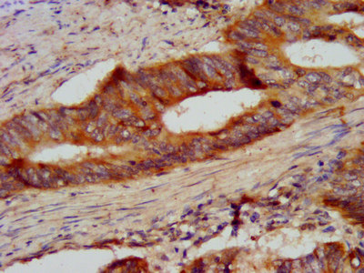 CSN2 / Beta Casein Antibody - Immunohistochemistry image at a dilution of 1:300 and staining in paraffin-embedded human colon cancer performed on a Leica BondTM system. After dewaxing and hydration, antigen retrieval was mediated by high pressure in a citrate buffer (pH 6.0) . Section was blocked with 10% normal goat serum 30min at RT. Then primary antibody (1% BSA) was incubated at 4 °C overnight. The primary is detected by a biotinylated secondary antibody and visualized using an HRP conjugated SP system.