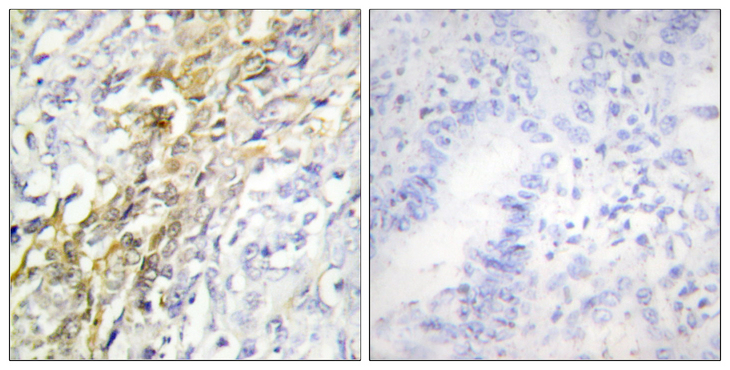 CSNK1A1 / CK1 Alpha Antibody - Immunohistochemistry analysis of paraffin-embedded human lung carcinoma tissue, using CKI-alpha Antibody. The picture on the right is blocked with the synthesized peptide.