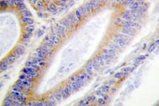 CSNK1A1 / CK1 Alpha Antibody - IHC of Casein Kinase I (Q317) pAb in paraffin-embedded human colon carcinoma tissue.