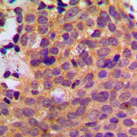 CSNK1A1 / CK1 Alpha Antibody - Immunohistochemical analysis of CK1 alpha staining in human breast cancer formalin fixed paraffin embedded tissue section. The section was pre-treated using heat mediated antigen retrieval with sodium citrate buffer (pH 6.0). The section was then incubated with the antibody at room temperature and detected using an HRP conjugated compact polymer system. DAB was used as the chromogen. The section was then counterstained with hematoxylin and mounted with DPX.