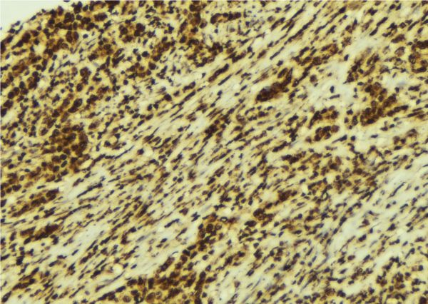 CSNK1A1 / CK1 Alpha Antibody - 1:100 staining human breast carcinoma tissue by IHC-P. The sample was formaldehyde fixed and a heat mediated antigen retrieval step in citrate buffer was performed. The sample was then blocked and incubated with the antibody for 1.5 hours at 22°C. An HRP conjugated goat anti-rabbit antibody was used as the secondary.