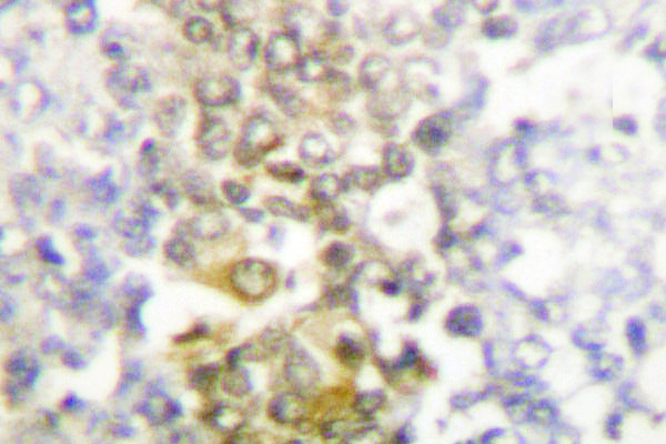 CSNK1A1 / CK1 Alpha Antibody - IHC of Casein Kinase I (F158) pAb in paraffin-embedded human lung carcinoma tissue.