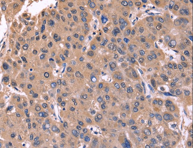 CSNK1D Antibody - Immunohistochemistry of paraffin-embedded Human liver cancer using CSNK1D Polyclonal Antibody at dilution of 1:50.
