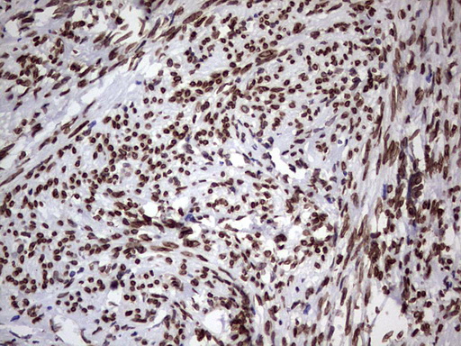 CSNK1E / CK1 Epsilon Antibody - IHC of paraffin-embedded Human endometrium tissue using anti-CSNK1E mouse monoclonal antibody. (Heat-induced epitope retrieval by 1 mM EDTA in 10mM Tris, pH8.5, 120°C for 3min).