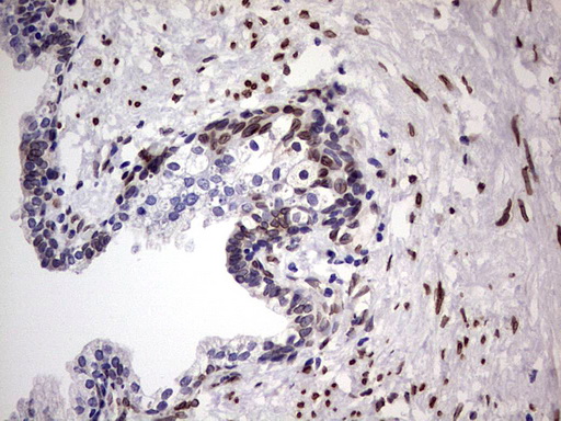 CSNK1E / CK1 Epsilon Antibody - IHC of paraffin-embedded Carcinoma of Human prostate tissue using anti-CSNK1E mouse monoclonal antibody. (Heat-induced epitope retrieval by 1 mM EDTA in 10mM Tris, pH8.5, 120°C for 3min).