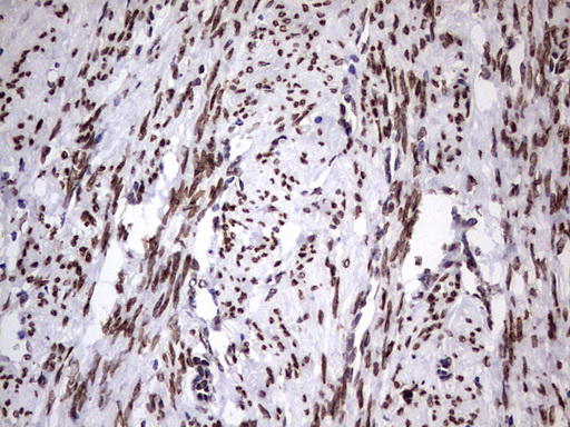 CSNK1E / CK1 Epsilon Antibody - IHC of paraffin-embedded Adenocarcinoma of Human endometrium tissue using anti-CSNK1E mouse monoclonal antibody. (Heat-induced epitope retrieval by 1 mM EDTA in 10mM Tris, pH8.5, 120°C for 3min).