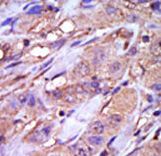 CSNK1E / CK1 Epsilon Antibody - Formalin-fixed and paraffin-embedded human cancer tissue reacted with the primary antibody, which was peroxidase-conjugated to the secondary antibody, followed by DAB staining. This data demonstrates the use of this antibody for immunohistochemistry; clinical relevance has not been evaluated. BC = breast carcinoma; HC = hepatocarcinoma.