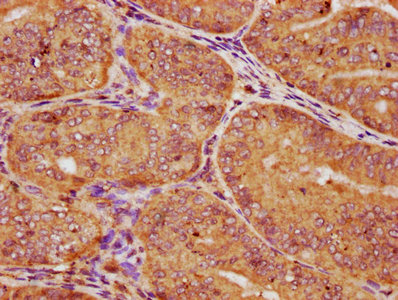 CSNK1E / CK1 Epsilon Antibody - IHC image of CSNK1E Antibody diluted at 1:150 and staining in paraffin-embedded human endometrial cancer performed on a Leica BondTM system. After dewaxing and hydration, antigen retrieval was mediated by high pressure in a citrate buffer (pH 6.0). Section was blocked with 10% normal goat serum 30min at RT. Then primary antibody (1% BSA) was incubated at 4°C overnight. The primary is detected by a biotinylated secondary antibody and visualized using an HRP conjugated SP system.