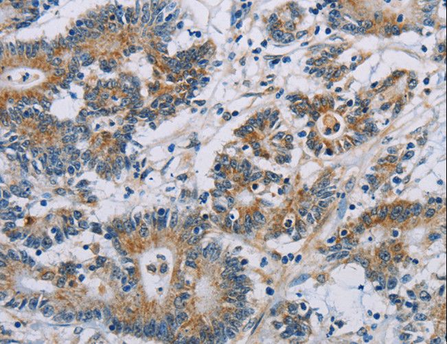 CSNK1E / CK1 Epsilon Antibody - Immunohistochemistry of paraffin-embedded Human colon cancer using CSNK1E Polyclonal Antibody at dilution of 1:60.
