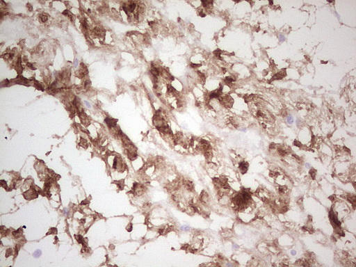 CSNK1G1 / CKI-Gamma 1 Antibody - IHC of paraffin-embedded Carcinoma of Human bladder tissue using anti-CSNK1G1 mouse monoclonal antibody. (Heat-induced epitope retrieval by 1 mM EDTA in 10mM Tris, pH8.5, 120°C for 3min).