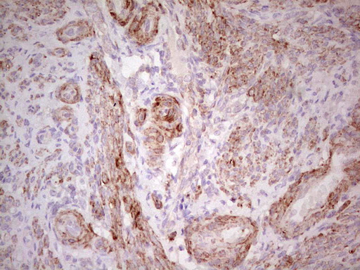 CSNK1G1 / CKI-Gamma 1 Antibody - Immunohistochemical staining of paraffin-embedded Human endometrium tissue within the normal limits using anti-CSNK1G1 mouse monoclonal antibody. (Heat-induced epitope retrieval by 1 mM EDTA in 10mM Tris, pH8.5, 120C for 3min,