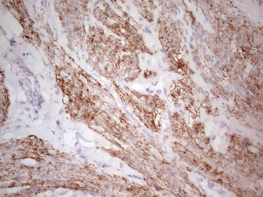 CSNK1G1 / CKI-Gamma 1 Antibody - Immunohistochemical staining of paraffin-embedded Adenocarcinoma of Human endometrium tissue using anti-CSNK1G1 mouse monoclonal antibody. (Heat-induced epitope retrieval by 1 mM EDTA in 10mM Tris, pH8.5, 120C for 3min,