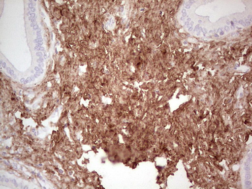 CSNK1G1 / CKI-Gamma 1 Antibody - Immunohistochemical staining of paraffin-embedded Carcinoma of Human pancreas tissue using anti-CSNK1G1 mouse monoclonal antibody. (Heat-induced epitope retrieval by 1 mM EDTA in 10mM Tris, pH8.5, 120C for 3min,