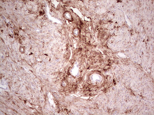 CSNK1G1 / CKI-Gamma 1 Antibody - Immunohistochemical staining of paraffin-embedded Adenocarcinoma of Human endometrium tissue using anti-CSNK1G1 mouse monoclonal antibody. (Heat-induced epitope retrieval by 1 mM EDTA in 10mM Tris, pH8.5, 120C for 3min,