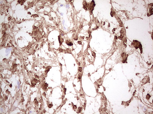 CSNK1G1 / CKI-Gamma 1 Antibody - Immunohistochemical staining of paraffin-embedded Carcinoma of Human bladder tissue using anti-CSNK1G1 mouse monoclonal antibody. (Heat-induced epitope retrieval by 1 mM EDTA in 10mM Tris, pH8.5, 120C for 3min,