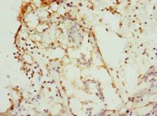 CSNK1G1 / CKI-Gamma 1 Antibody - Immunohistochemistry of paraffin-embedded human breast cancer at dilution 1:100