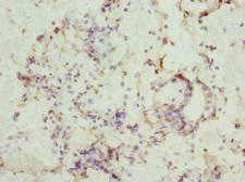 CSNK1G1 / CKI-Gamma 1 Antibody - Immunohistochemistry of paraffin-embedded human breast cancer at dilution 1:100
