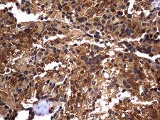 CSNK1G2 / CKI-Gamma 2 Antibody - IHC of paraffin-embedded Adenocarcinoma of Human breast tissue using anti-CSNK1G2 mouse monoclonal antibody. (Heat-induced epitope retrieval by 1 mM EDTA in 10mM Tris, pH8.5, 120°C for 3min).