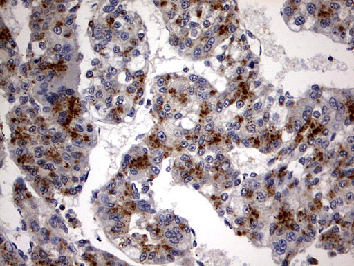 CSNK1G2 / CKI-Gamma 2 Antibody - IHC of paraffin-embedded Carcinoma of Human liver tissue using anti-CSNK1G2 mouse monoclonal antibody. (Heat-induced epitope retrieval by 1 mM EDTA in 10mM Tris, pH8.5, 120°C for 3min).