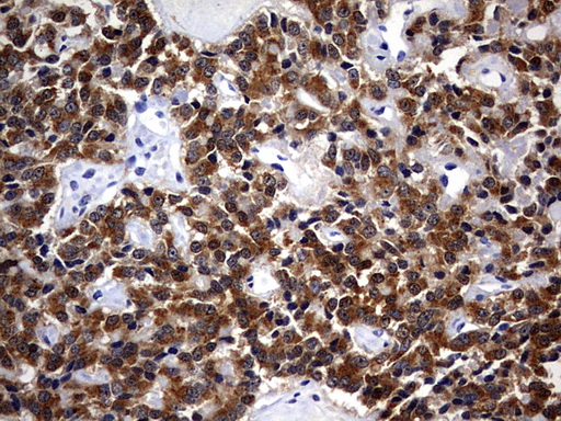 CSNK1G2 / CKI-Gamma 2 Antibody - IHC of paraffin-embedded Carcinoma of Human pancreas tissue using anti-CSNK1G2 mouse monoclonal antibody. (Heat-induced epitope retrieval by 1 mM EDTA in 10mM Tris, pH8.5, 120°C for 3min).