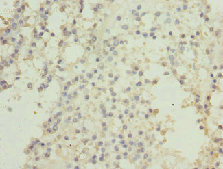 CSNK1G2 / CKI-Gamma 2 Antibody - Immunohistochemistry of paraffin-embedded human breast cancer at dilution 1:100