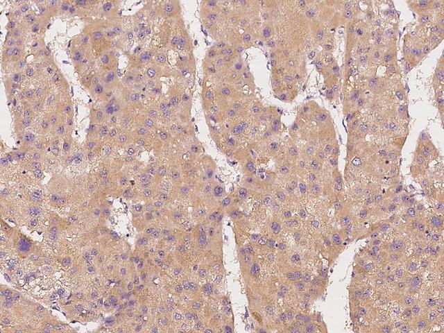 CSNK1G2 / CKI-Gamma 2 Antibody - Immunochemical staining of human CSNK1G2 in human hepatoma with rabbit polyclonal antibody at 1:200 dilution, formalin-fixed paraffin embedded sections.