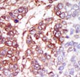 CSNK1G3 / CKI-Gamma 3 Antibody - Formalin-fixed and paraffin-embedded human cancer tissue reacted with the primary antibody, which was peroxidase-conjugated to the secondary antibody, followed by DAB staining. This data demonstrates the use of this antibody for immunohistochemistry; clinical relevance has not been evaluated. BC = breast carcinoma; HC = hepatocarcinoma.