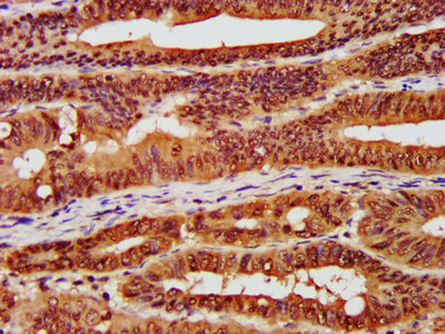 CSNK2A1 Antibody - IHC image of CSNK2A1 Antibody diluted at 1:300 and staining in paraffin-embedded human colon cancer performed on a Leica BondTM system. After dewaxing and hydration, antigen retrieval was mediated by high pressure in a citrate buffer (pH 6.0). Section was blocked with 10% normal goat serum 30min at RT. Then primary antibody (1% BSA) was incubated at 4°C overnight. The primary is detected by a biotinylated secondary antibody and visualized using an HRP conjugated SP system.