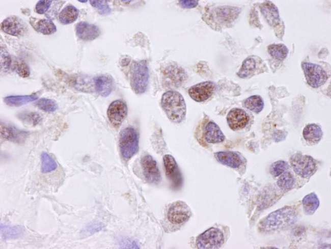CSNK2A1 Antibody - Detection of Human CKII alpha by Immunohistochemistry. Sample: FFPE section of human lung non-small cell carcinoma. Antibody: Affinity purified rabbit anti-CKII alpha used at a dilution of 1:250. Detection: DAB.