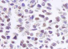 CSNK2A1 Antibody - Detection of Human CKII Alpha by Immunohistochemistry. Sample: FFPE section of human non-small cell lung cancer. Antibody: Affinity purified rabbit anti-CKII Alpha used at a dilution of 1:1000 (1 ug/ml).