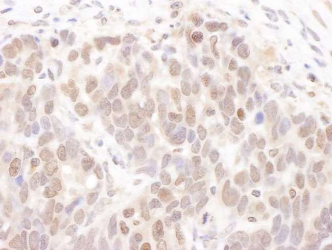 CSNK2A1 Antibody - Detection of Human CKII Alpha by Immunohistochemistry. Sample: FFPE section of human ovarian carcinoma. Antibody: Affinity purified rabbit anti-CKII Alpha used at a dilution of 1:5000 (0.2 ug/ml).