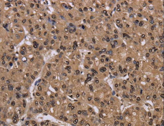CSNK2A1 Antibody - Immunohistochemistry of paraffin-embedded Human liver cancer using CSNK2A1 Polyclonal Antibody at dilution of 1:30.