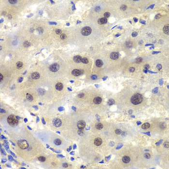 CSNK2A2 Antibody - Immunohistochemistry of paraffin-embedded human liver cancer tissue.