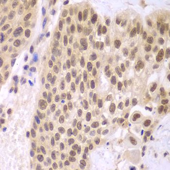 CSNK2A2 Antibody - Immunohistochemistry of paraffin-embedded human lung cancer using CSNK2A2 antibody at dilution of 1:100 (40x lens).