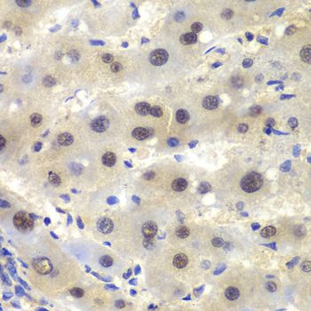 CSNK2A2 Antibody - Immunohistochemistry of paraffin-embedded human liver cancer using CSNK2A2 antibody at dilution of 1:100 (40x lens).